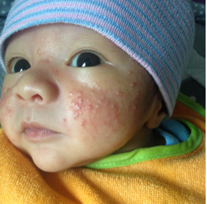 Image result for baby acne