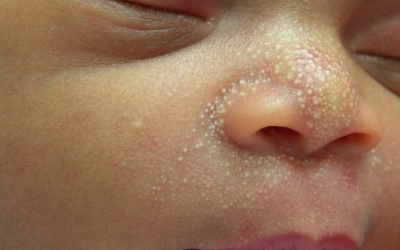 RASHES IN BABIES