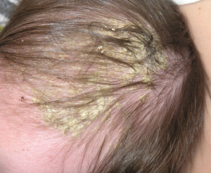 cradle-cap